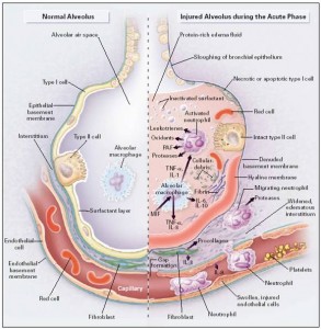 Pathophysiology of ARDS