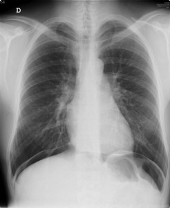 rx-torax-np rx-torax-np